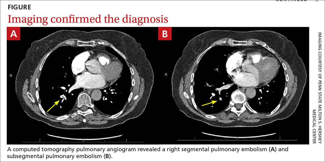 A computed tomography pulmonary angiogram