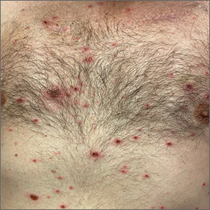 Skin lesions