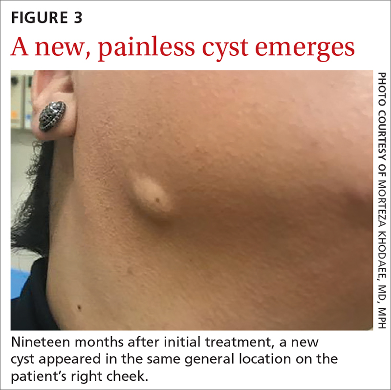 A new, painless cyst emerges