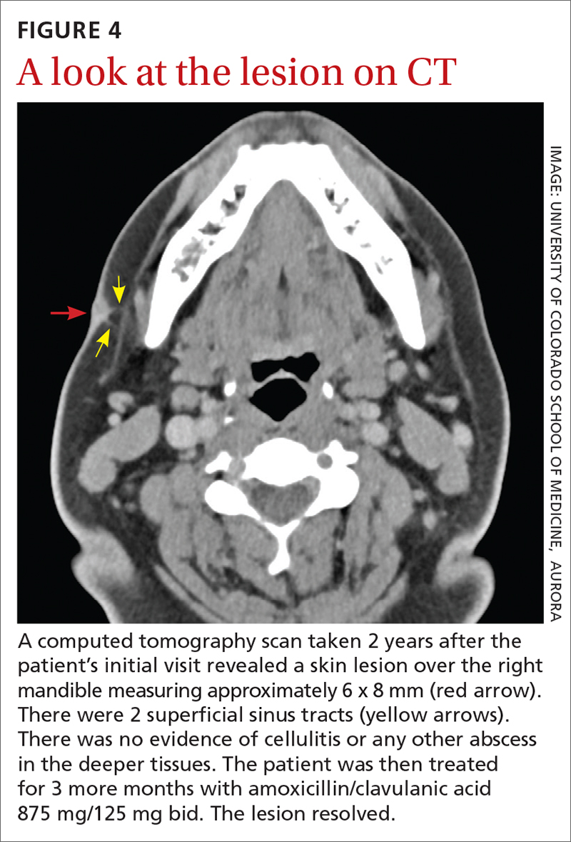 A look at the lesion on CT 