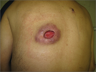 Nonhealing incision and drainage site MDedge Family Medicine
