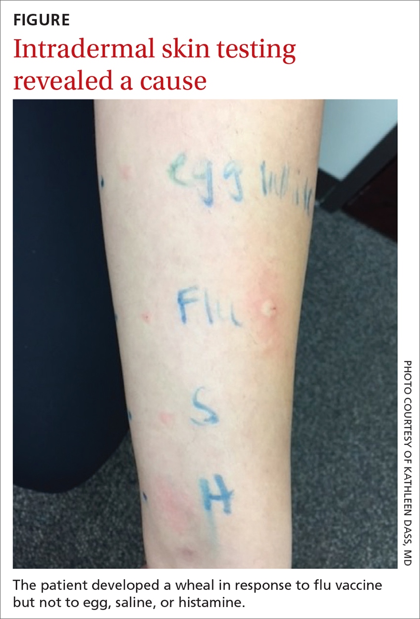 Image of the patient developed a wheal in response to flu vaccine but not to egg, saline, or histamine.