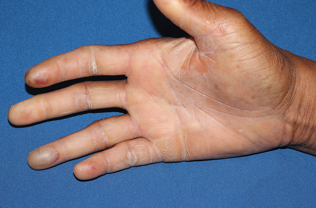 Image of Tense burn bullae attributed to holding a hot coffee cup were noted on the fingertips. The patient’s skin was also firm and taut, with tethering on the central palm.