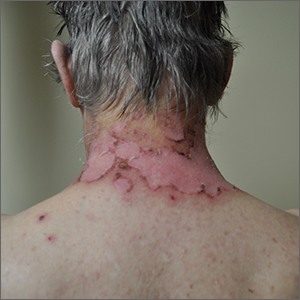 image of man with red lesion on neck 