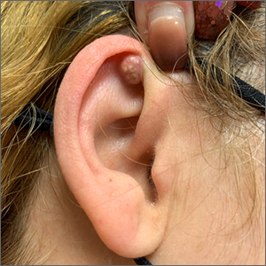 image of ear with abscess