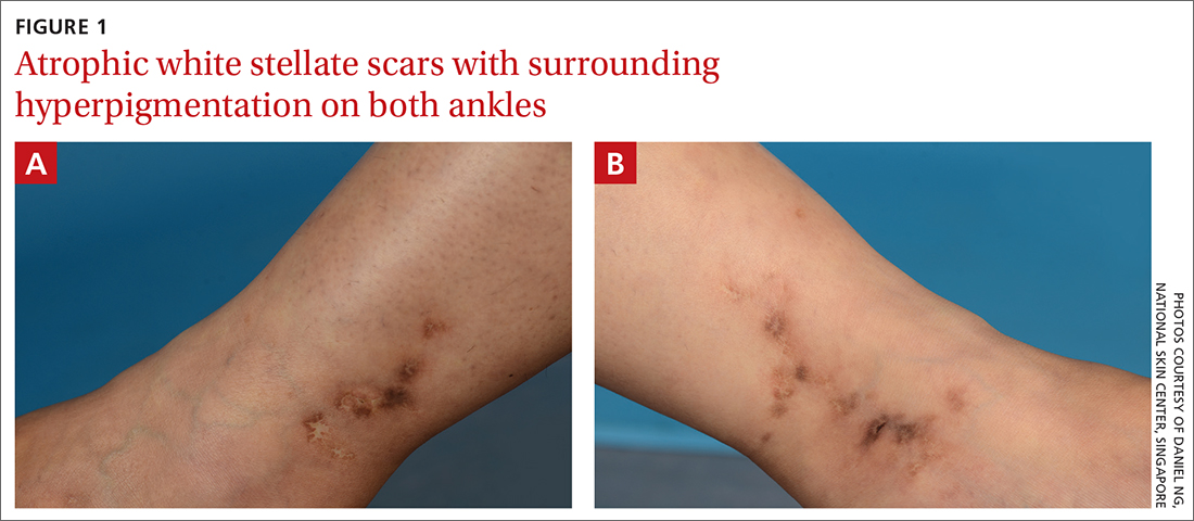 Figure 1 of atrophic white stellate scars with surrounding hyperpigmentation on both ankles