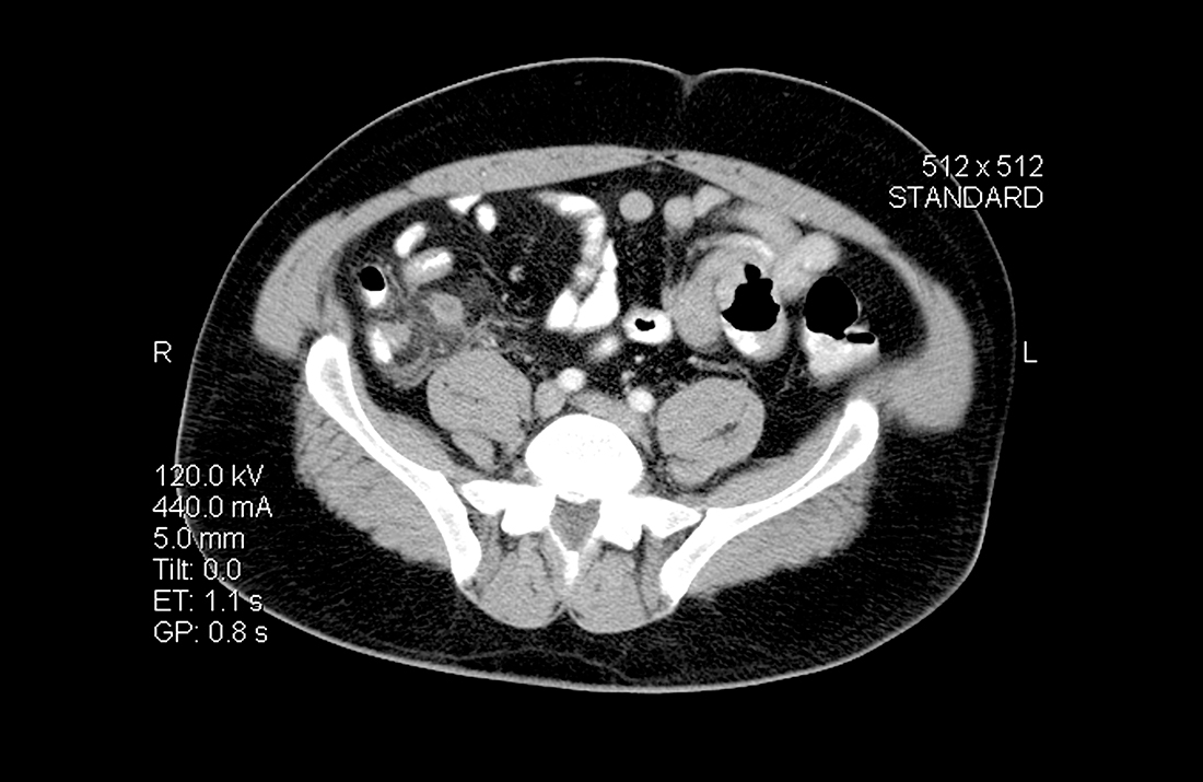 Appendicitis