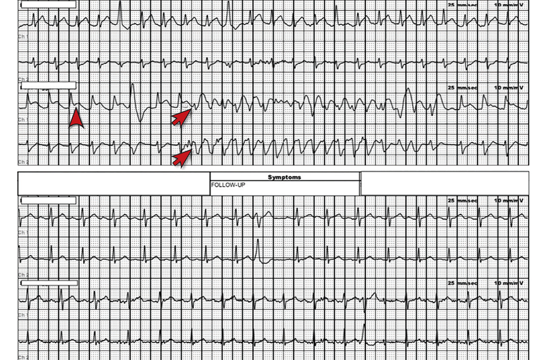 A “concerning” rhythm strip prompted action