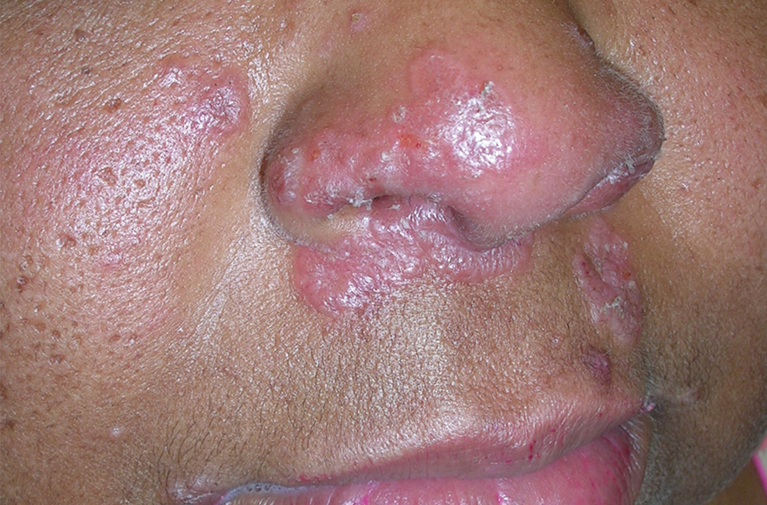 Pink, elevated, granulomatous, indurated plaques on the face, including the nasal alae