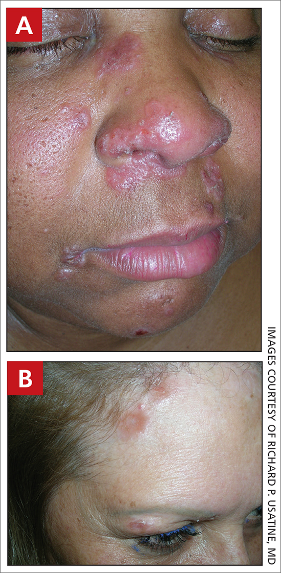 Pink, elevated, granulomatous, indurated plaques on the face, including the nasal alae