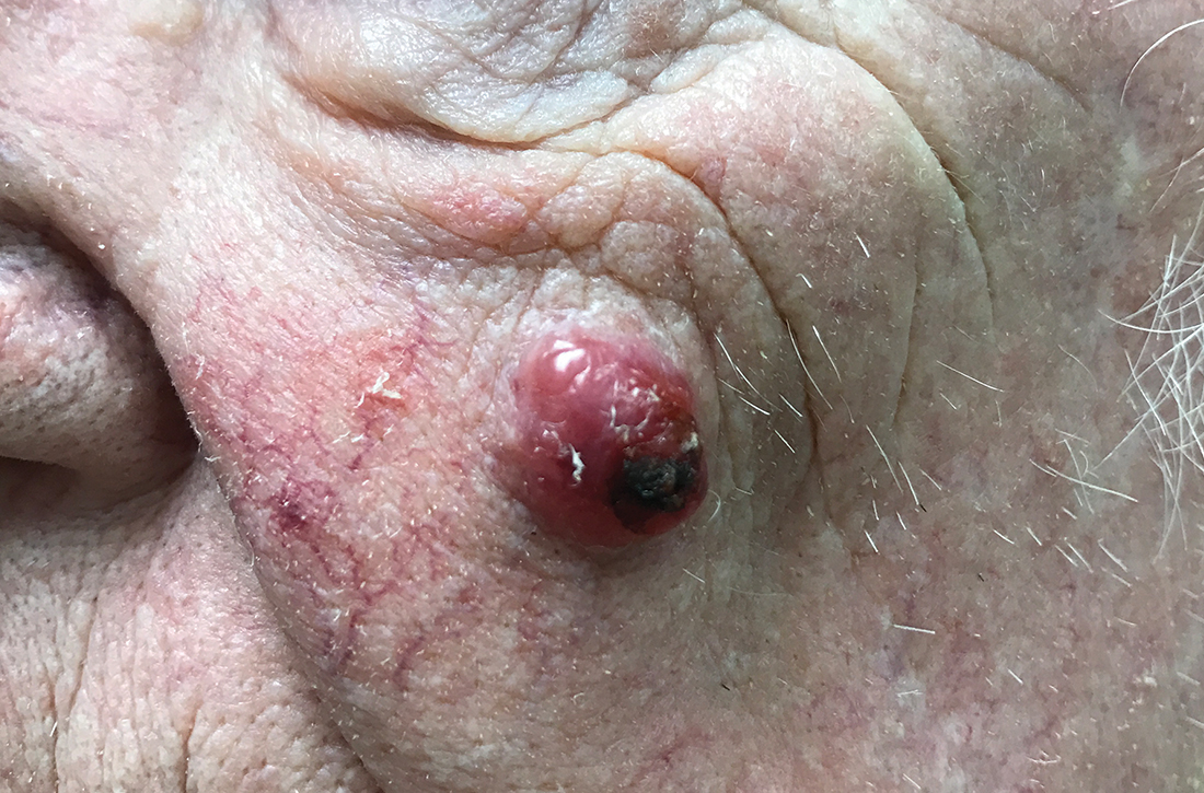 Plum-colored nodule on left cheek