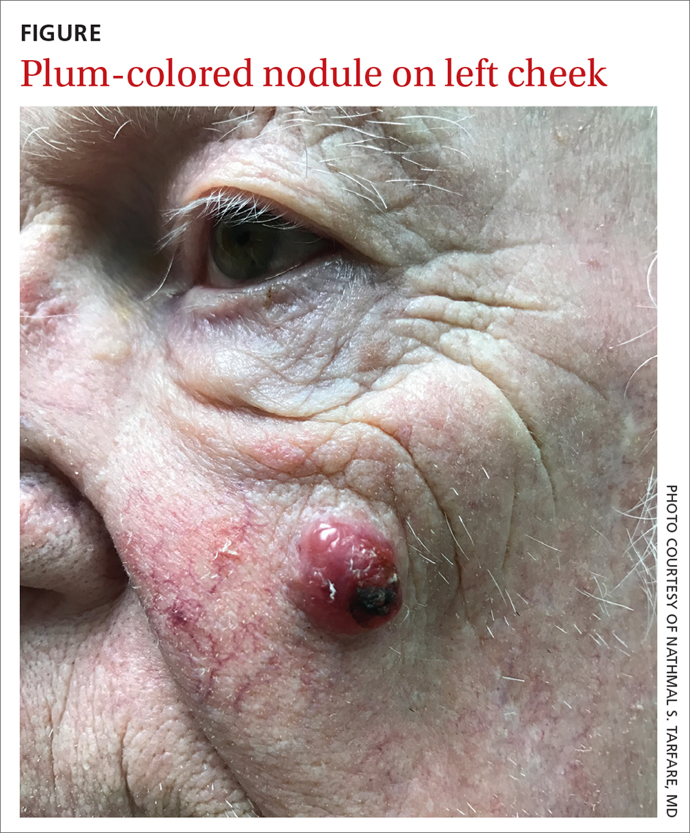 Plum-colored nodule on left cheek