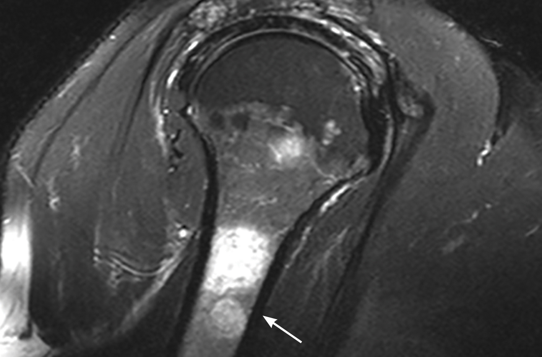 MRI reveals lesions on right shoulder 