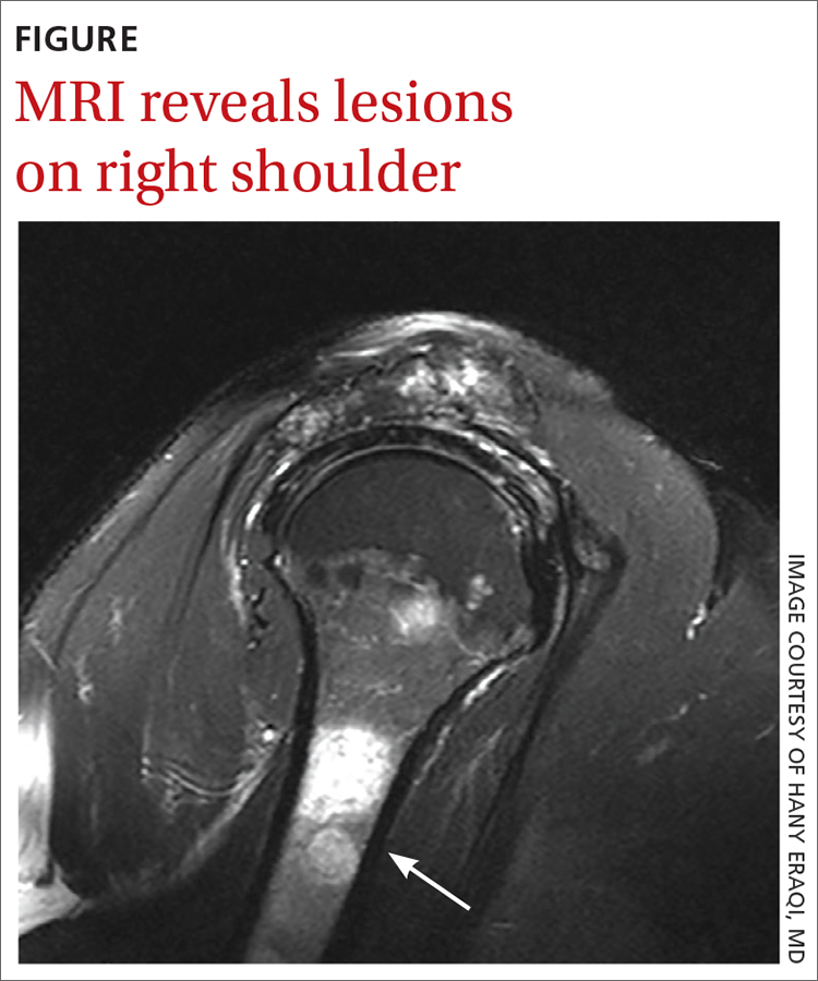 MRI reveals lesions on right shoulder 