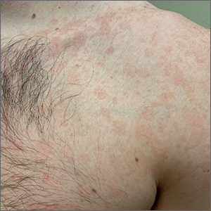 Chronic truncal rash