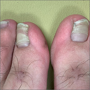 Toenail ridges