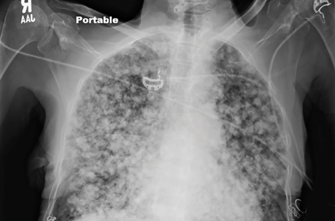 Soft-tissue densities in bilateral lungs on x-ray