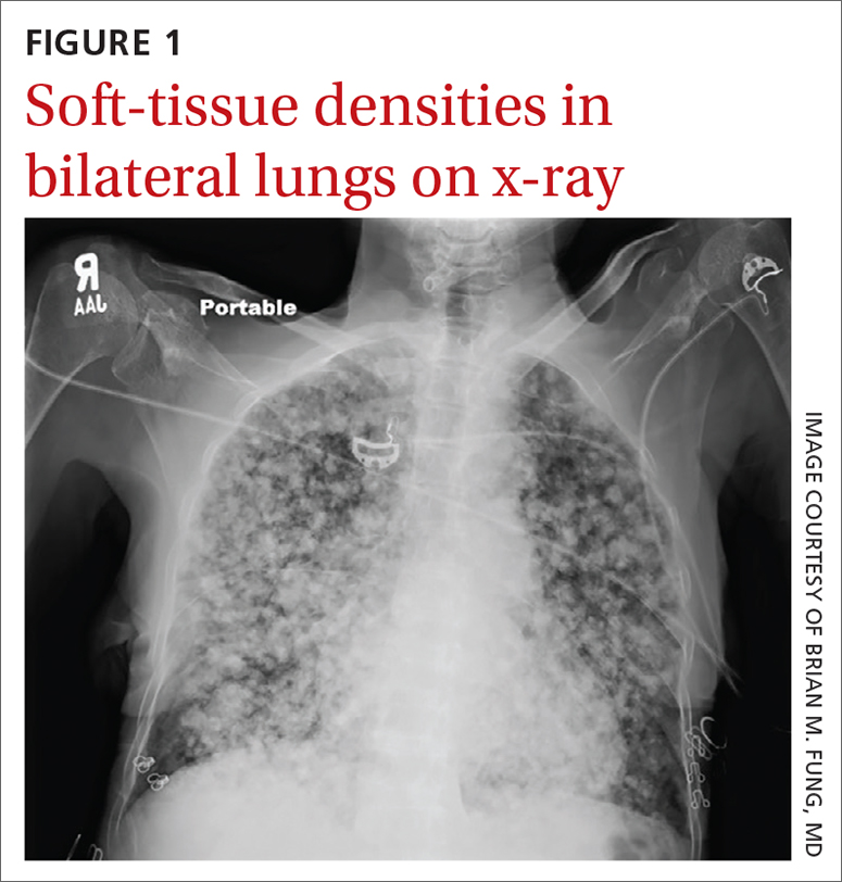 Soft-tissue densities in bilateral lungs on x-ray