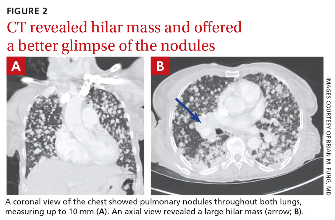 CT revealed hilar mass and offered a better glimpse of the nodules