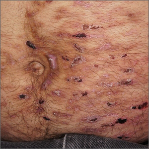 Abdominal rash