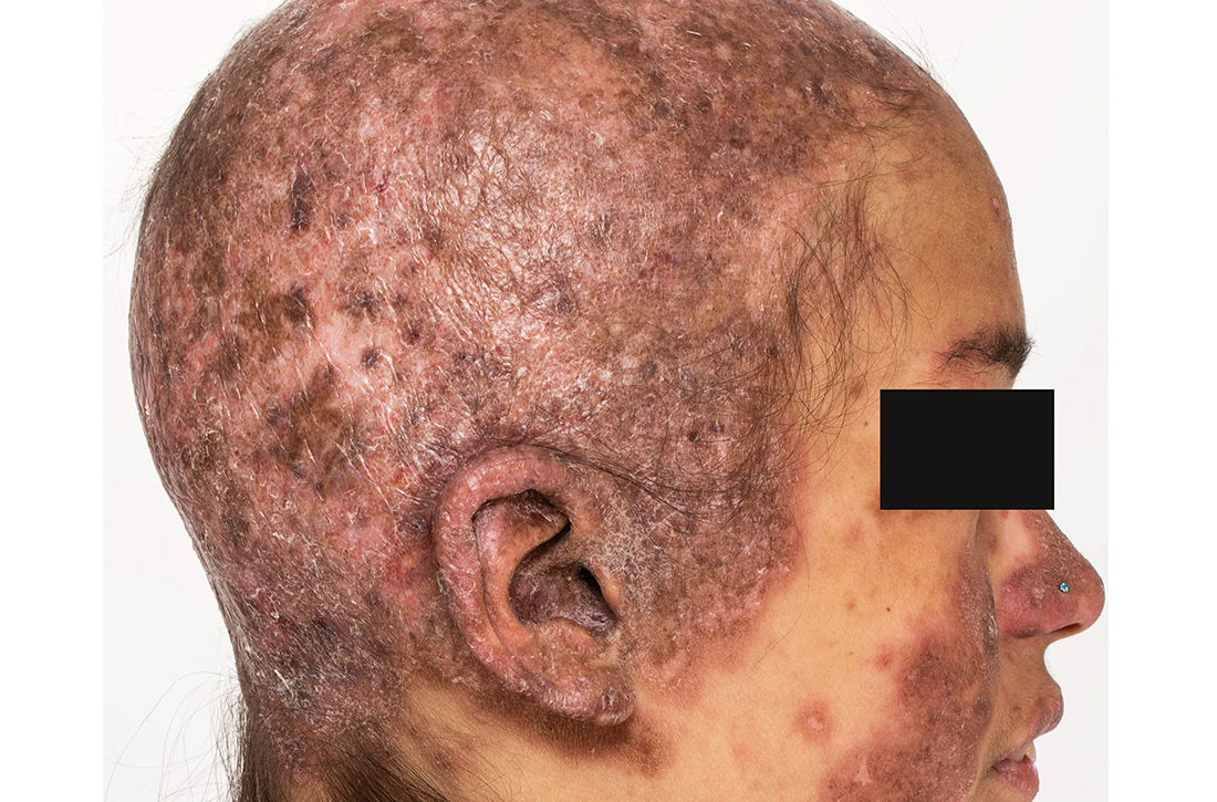 Diffuse scarring alopecia with abnormal pigmentation of scalp