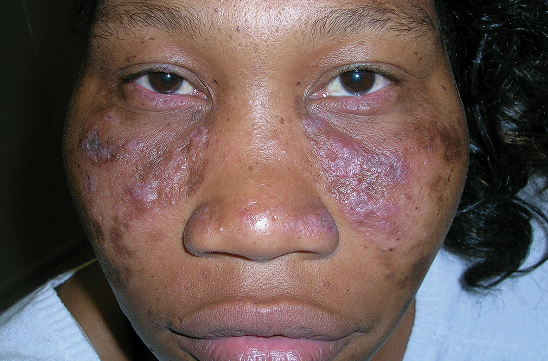 Multicolored (pink, brown, and white) indurated plaques in a butterfly distribution on the face of a 30-year-old woman with a darker skin tone