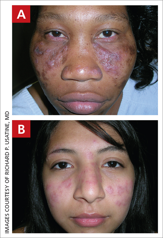 Discoid lupus