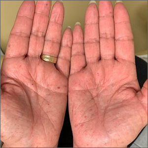 Bilateral palmar rash