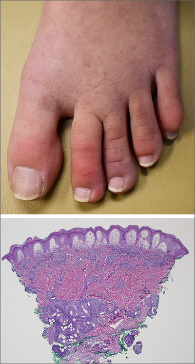 Swollen Purple Feet: Causes, Diagnosis and Treatment