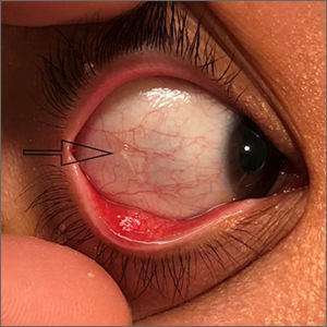 Unilateral eye irritation