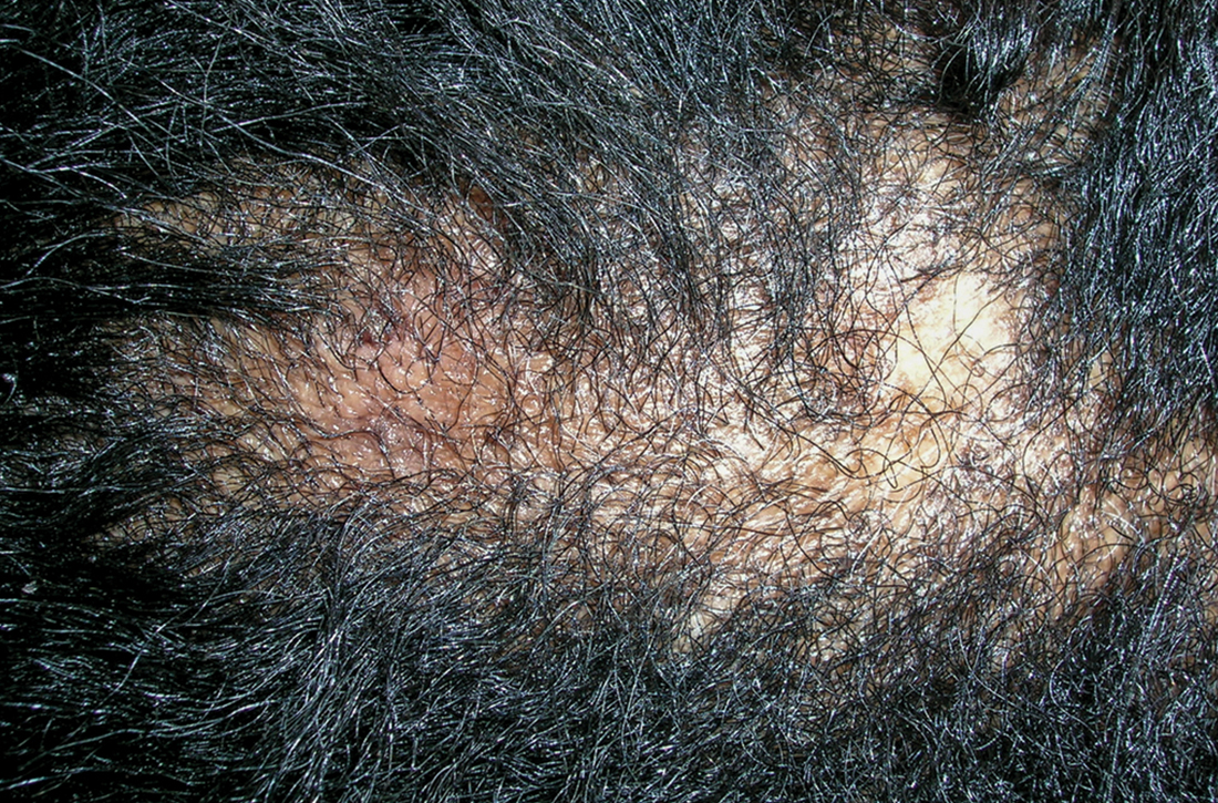 Central centrifugal cicatricial alopecia