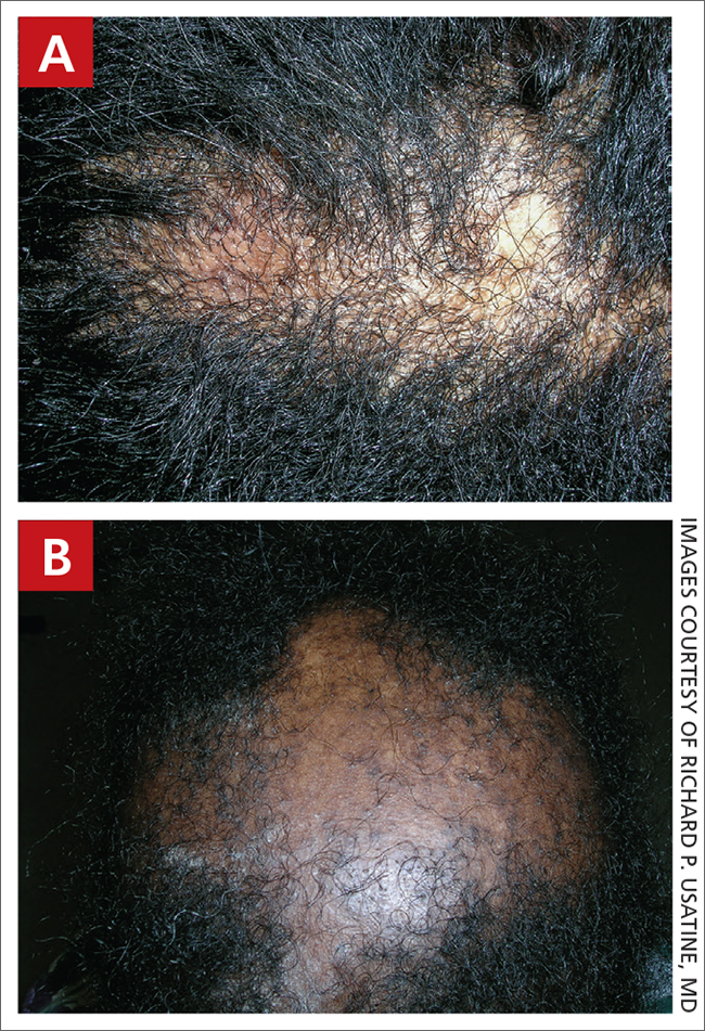 Central centrifugal cicatricial alopecia