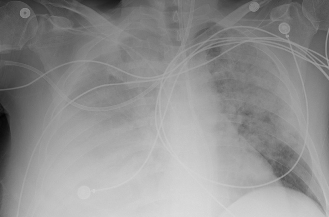 X-ray revealed right-side pleural effusion