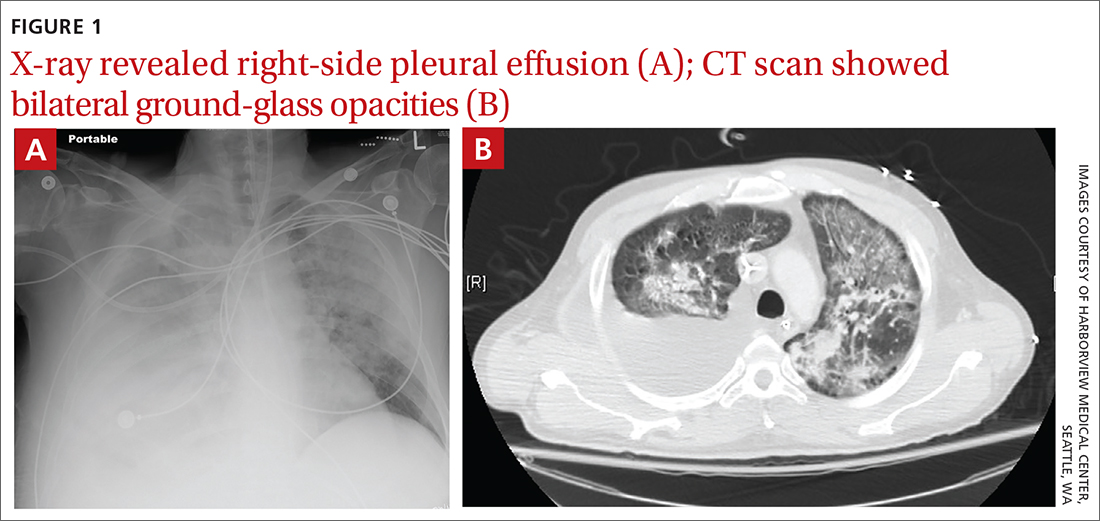 X-ray revealed right-side pleural effusion (A); CT scan showed bilateral ground-glass opacities (B)