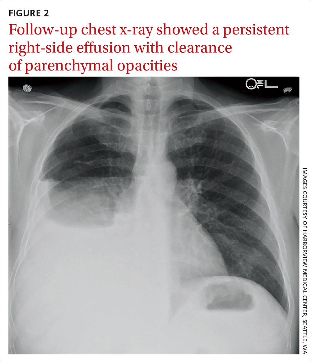 Follow-up chest x-ray showed a persistent right-side effusion with clearance of parenchymal opacities