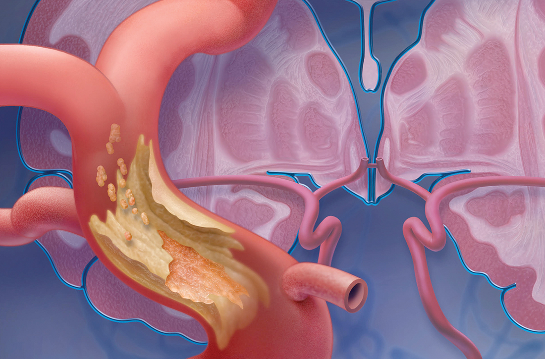 Transient ischemic attack