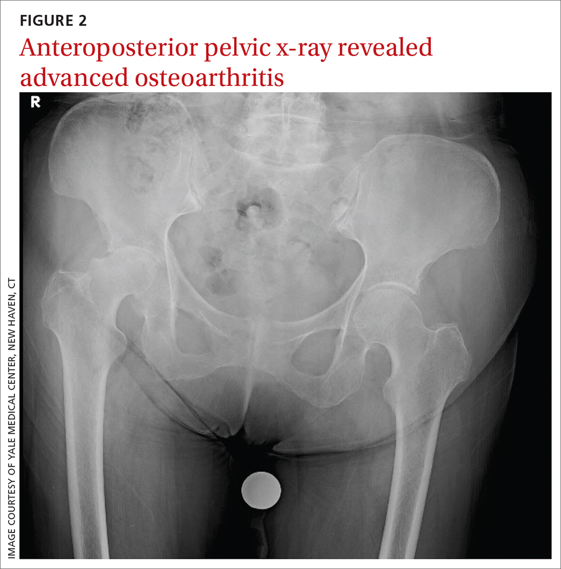 Osteoarthritis - Connecticut Orthopaedics