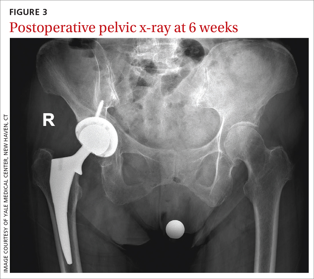 Postoperative pelvic x-ray at 6 weeks