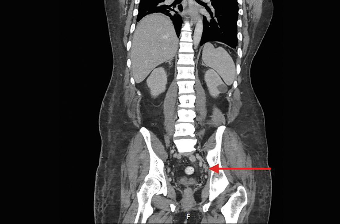 Occult inguinal lymphadenopathy