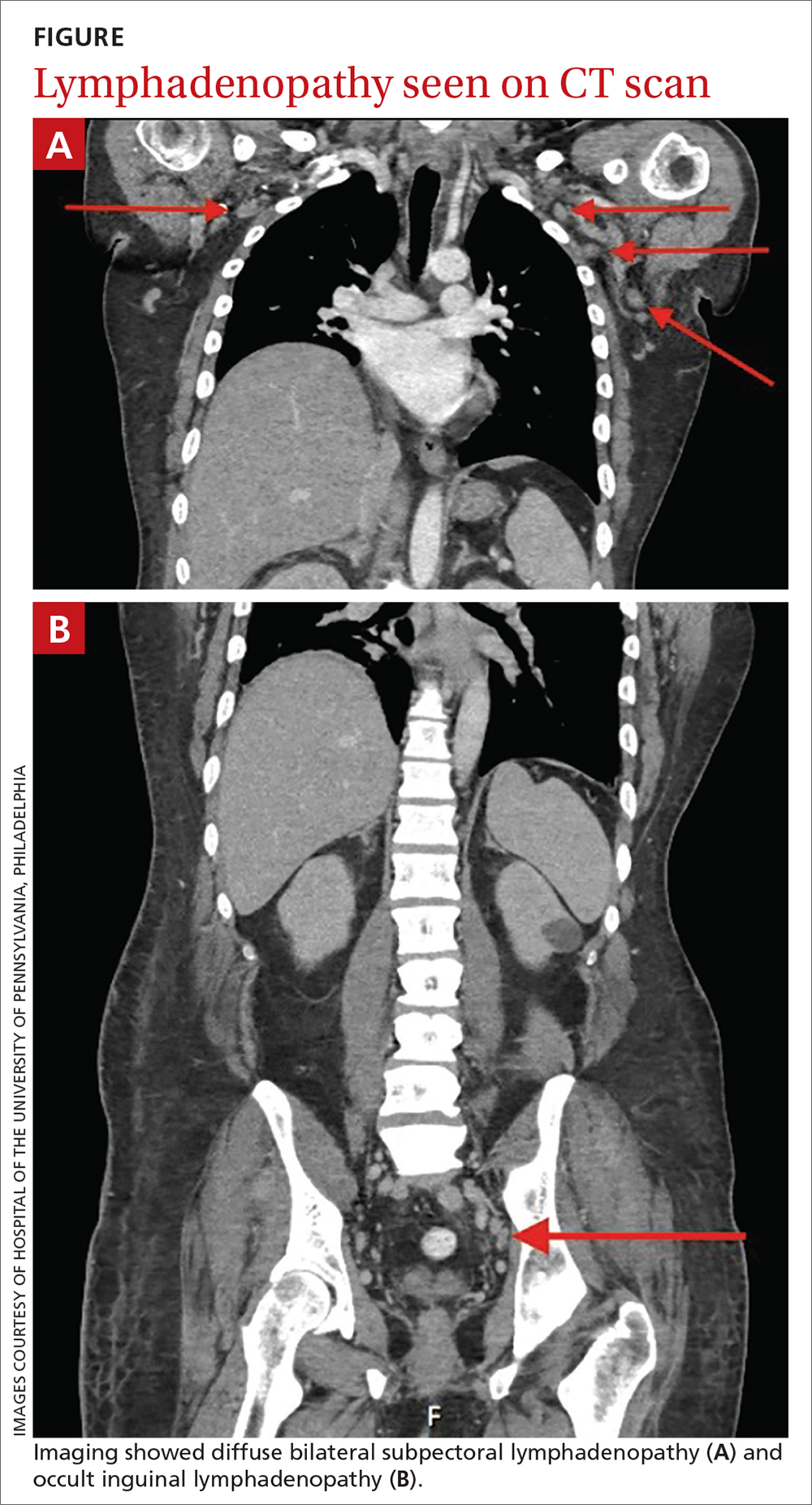 Lymphadenopathy seen on CT scan