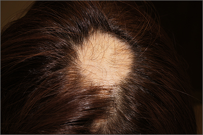 Focal hair loss | MDedge Family Medicine