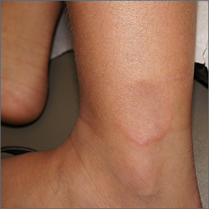 Smooth plaque on ankle