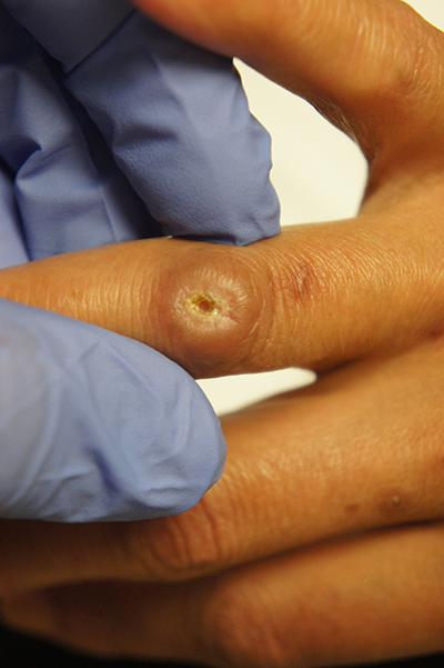 skin ulcer on finger