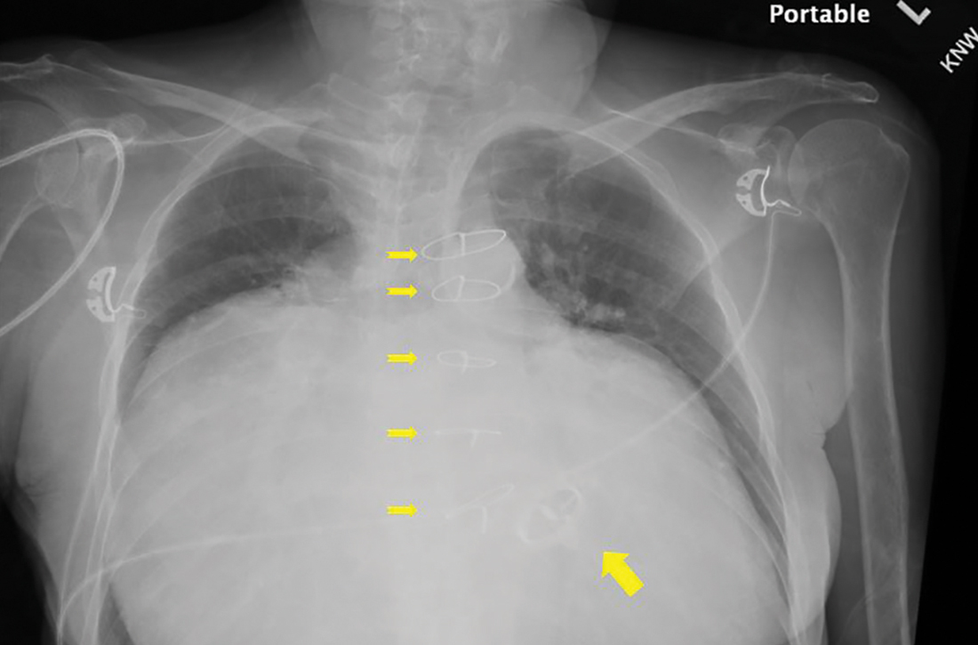 Enlarged cardiac silhouette on chest x-ray