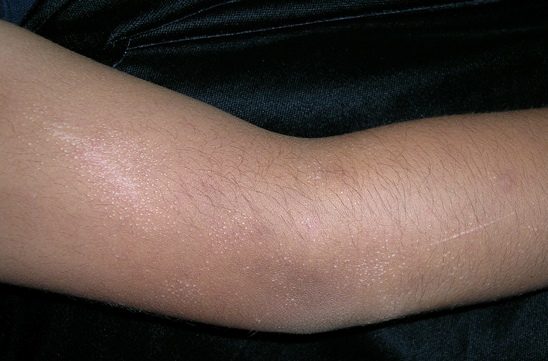 Multiple hypopigmented micropapules on arm