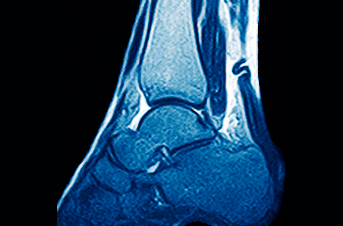 Achilles tendon rupture