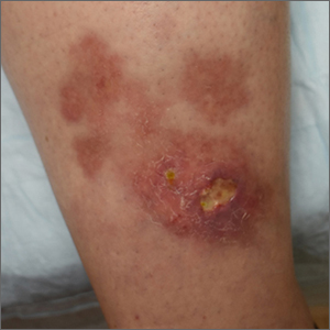 Ulcerated lower leg lesion