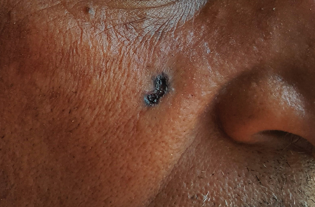 Nodular BCC on the cheek