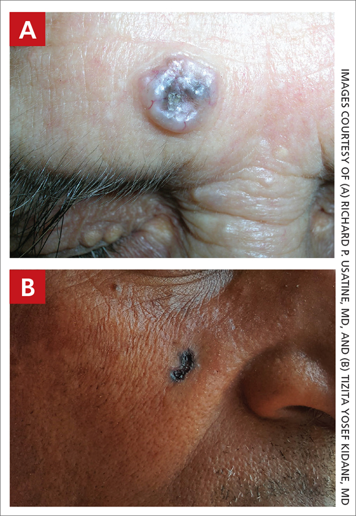 Basal cell carcinoma