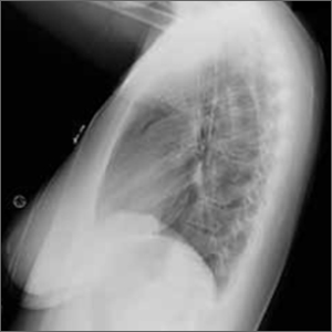 Chest pain and difficulty swallowing